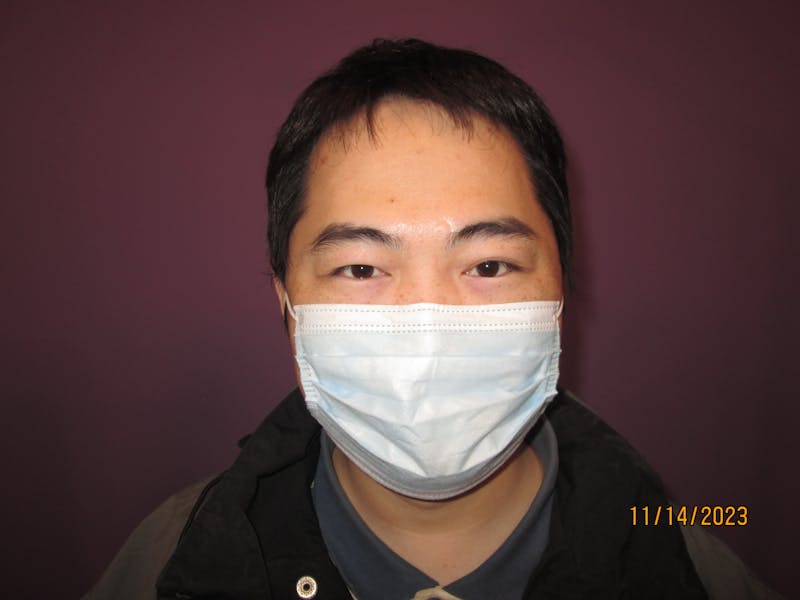 Exotropia Before & After Gallery - Patient 171446 - Image 2