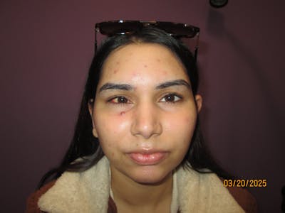 Exotropia Before & After Gallery - Patient 293568 - Image 2
