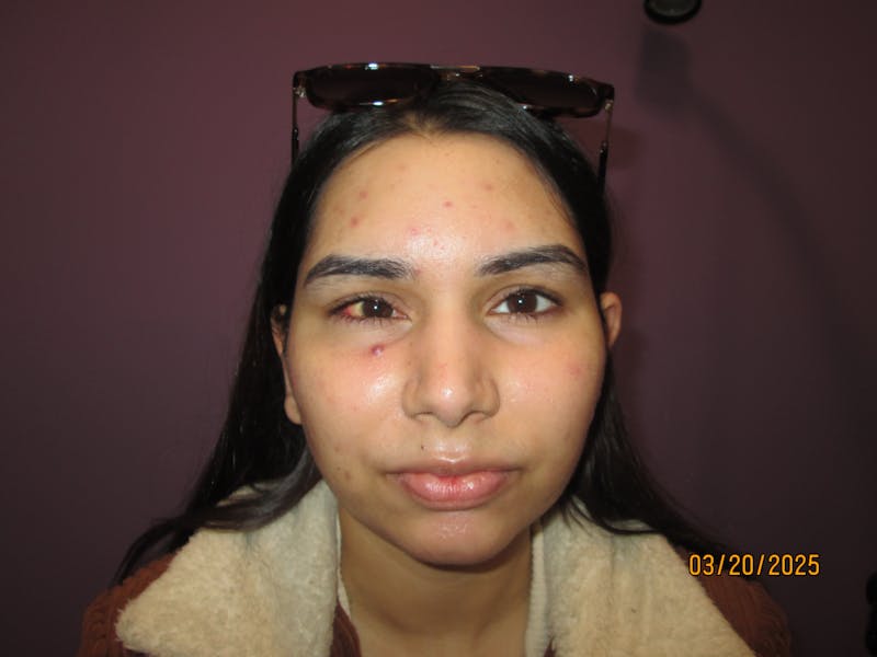 Exotropia Before & After Gallery - Patient 293568 - Image 2