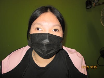 Exotropia Before & After Gallery - Patient 386579 - Image 1