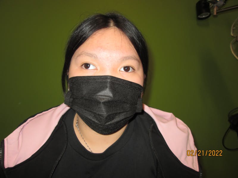 Exotropia Before & After Gallery - Patient 386579 - Image 1
