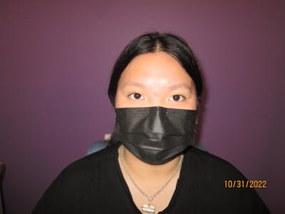 Exotropia Before & After Gallery - Patient 386579 - Image 2