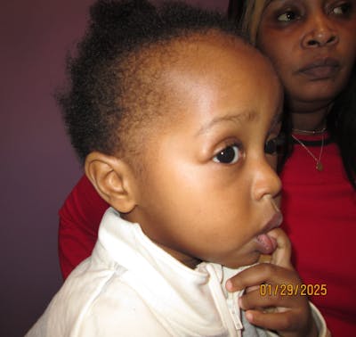 Dermoid Before & After Gallery - Patient 346269 - Image 1