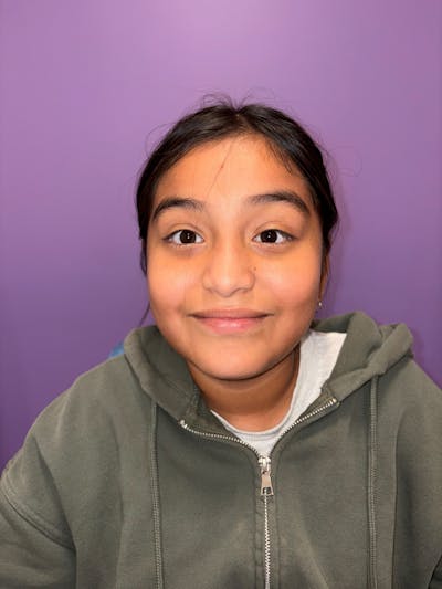 Esotropia Before & After Gallery - Patient 268169 - Image 2
