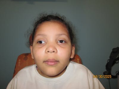 Exotropia Before & After Gallery - Patient 111297 - Image 1