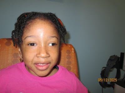 Exotropia Before & After Gallery - Patient 103503 - Image 1