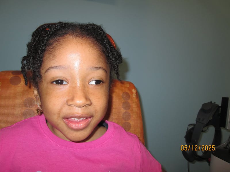 Exotropia Before & After Gallery - Patient 103503 - Image 1
