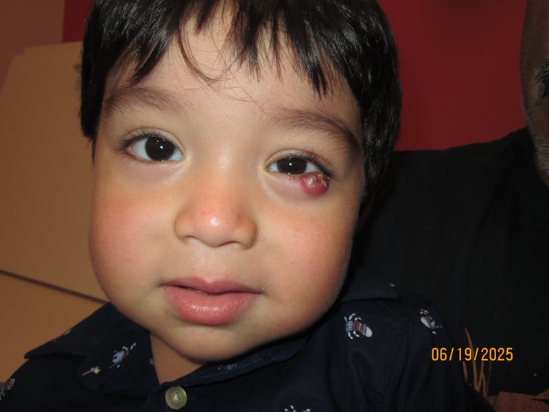 Chalazion Before & After Gallery - Patient 838461 - Image 1