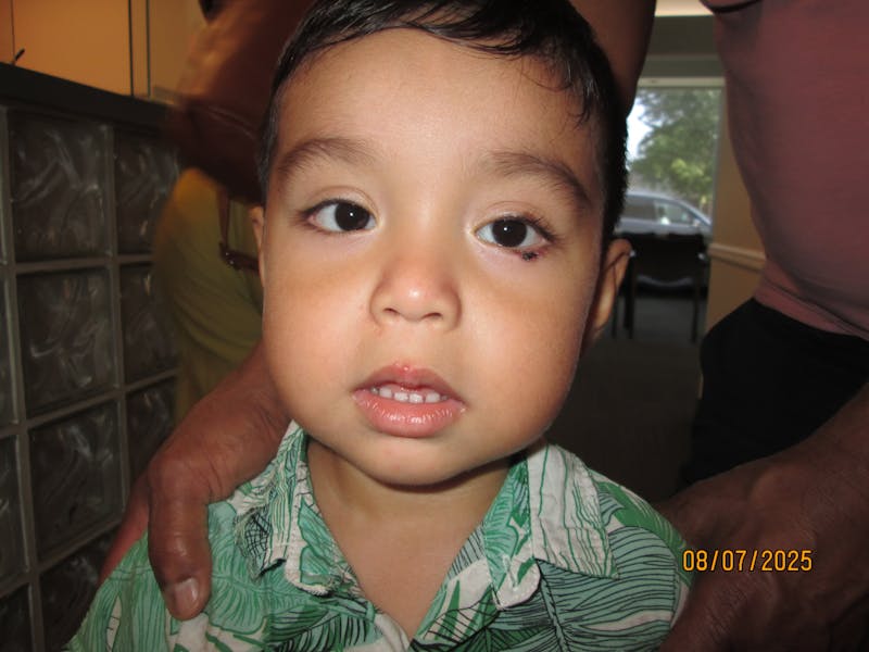 Chalazion Before & After Gallery - Patient 838461 - Image 2