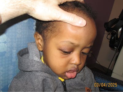 Dermoid Before & After Gallery - Patient 346269 - Image 2