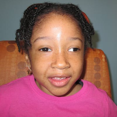 Exotropia Before & After Gallery - Patient 315321 - Image 1