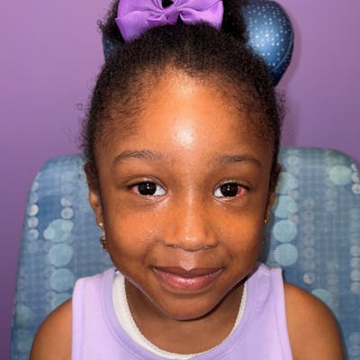 Exotropia Before & After Gallery - Patient 315321 - Image 2