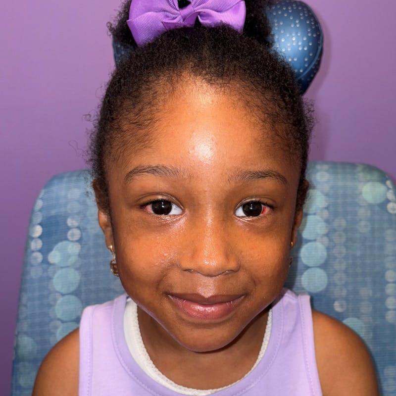 Exotropia Before & After Gallery - Patient 315321 - Image 2