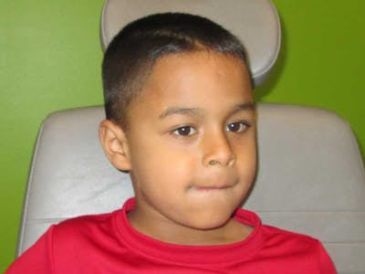 Complex Strabismus Before & After Gallery - Patient 374643 - Image 1