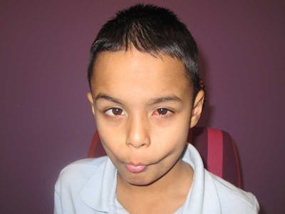 Complex Strabismus Before & After Gallery - Patient 374643 - Image 2