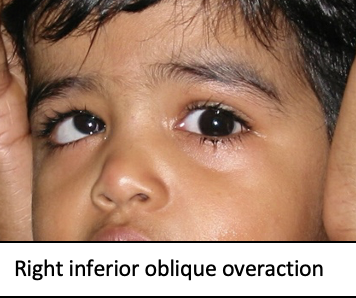 Head tilt compensation