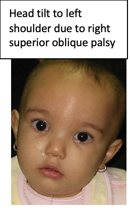 Misdiagnosed torticollis