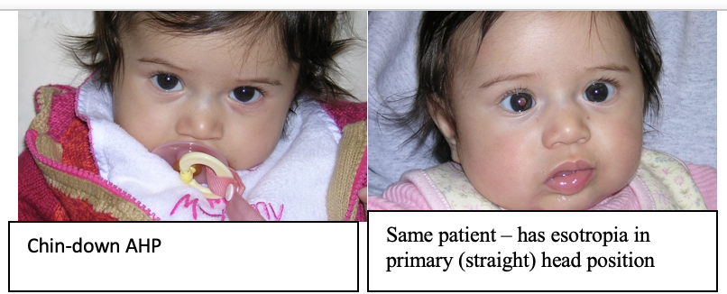V-pattern strabismus