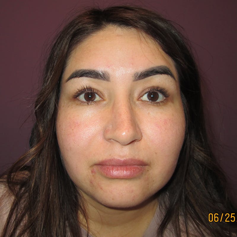 Exotropia Before & After Gallery - Patient 163467 - Image 1