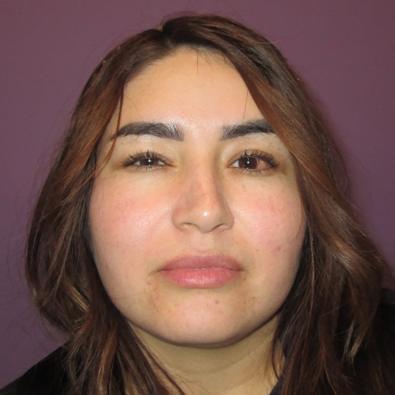 Exotropia Before & After Gallery - Patient 163467 - Image 3