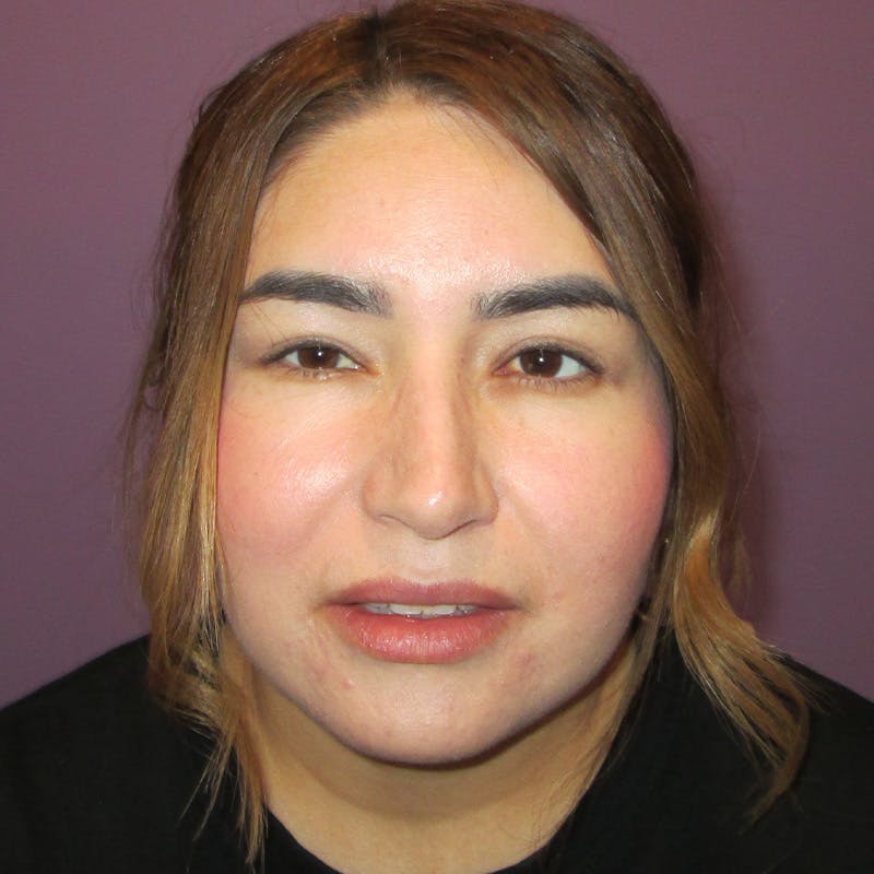 Exotropia Before & After Gallery - Patient 163467 - Image 2