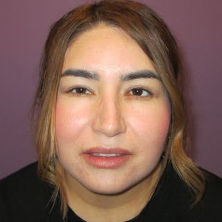 Exotropia Before & After Gallery - Patient 163467 - Image 2