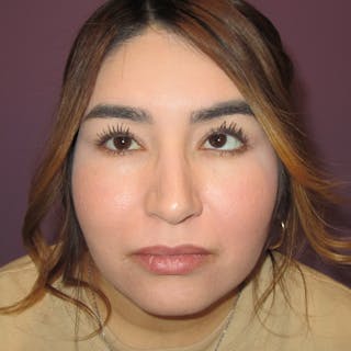 Exotropia Before & After Gallery - Patient 163467 - Image 4