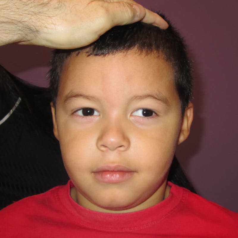 Exotropia Before & After Gallery - Patient 367841 - Image 1