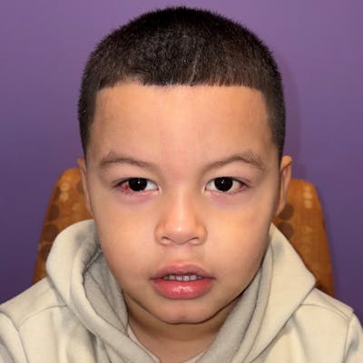 Exotropia Before & After Gallery - Patient 367841 - Image 2
