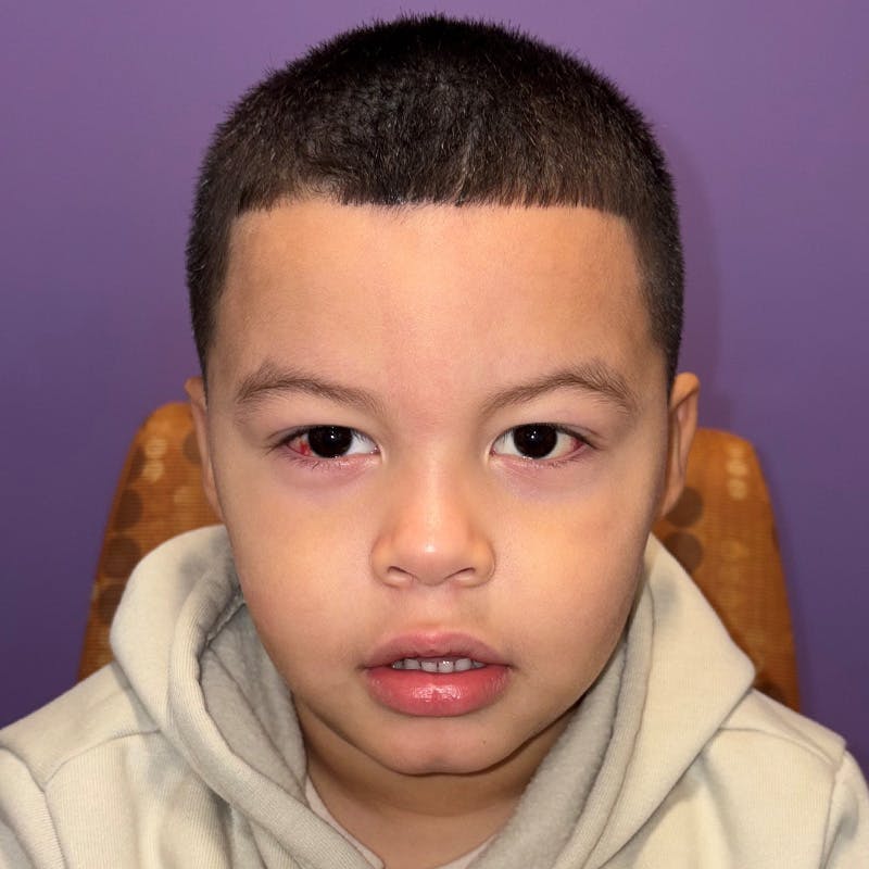 Exotropia Before & After Gallery - Patient 367841 - Image 2