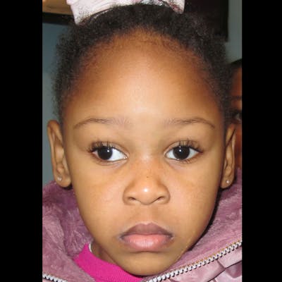 Exotropia Before & After Gallery - Patient 282722 - Image 1