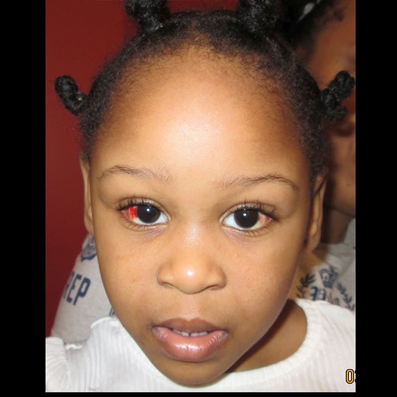 Exotropia Before & After Gallery - Patient 282722 - Image 2