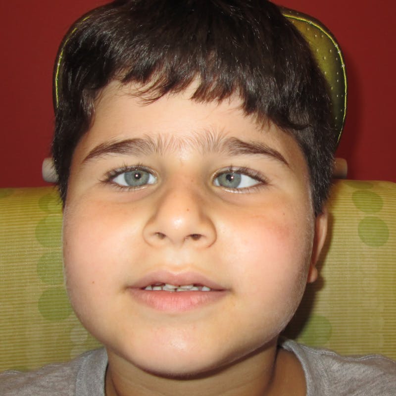 Esotropia Before & After Gallery - Patient 424829 - Image 1