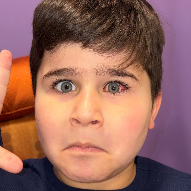 Esotropia Before & After Gallery - Patient 424829 - Image 2