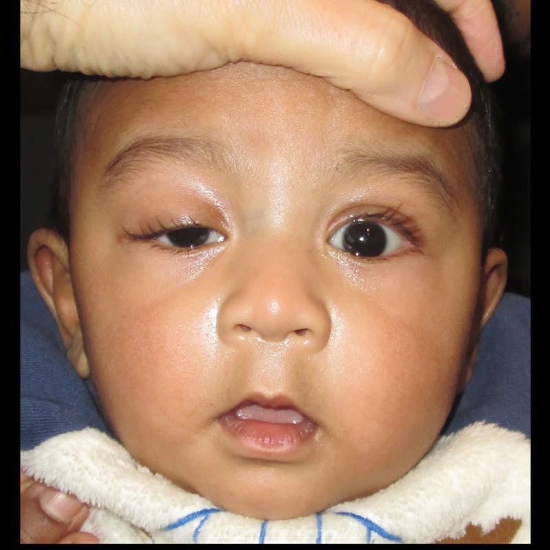Ptosis Before & After Gallery - Patient 225039 - Image 1