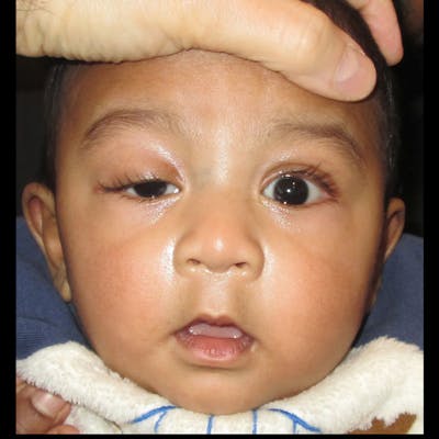 Ptosis Before & After Gallery - Patient 225039 - Image 1