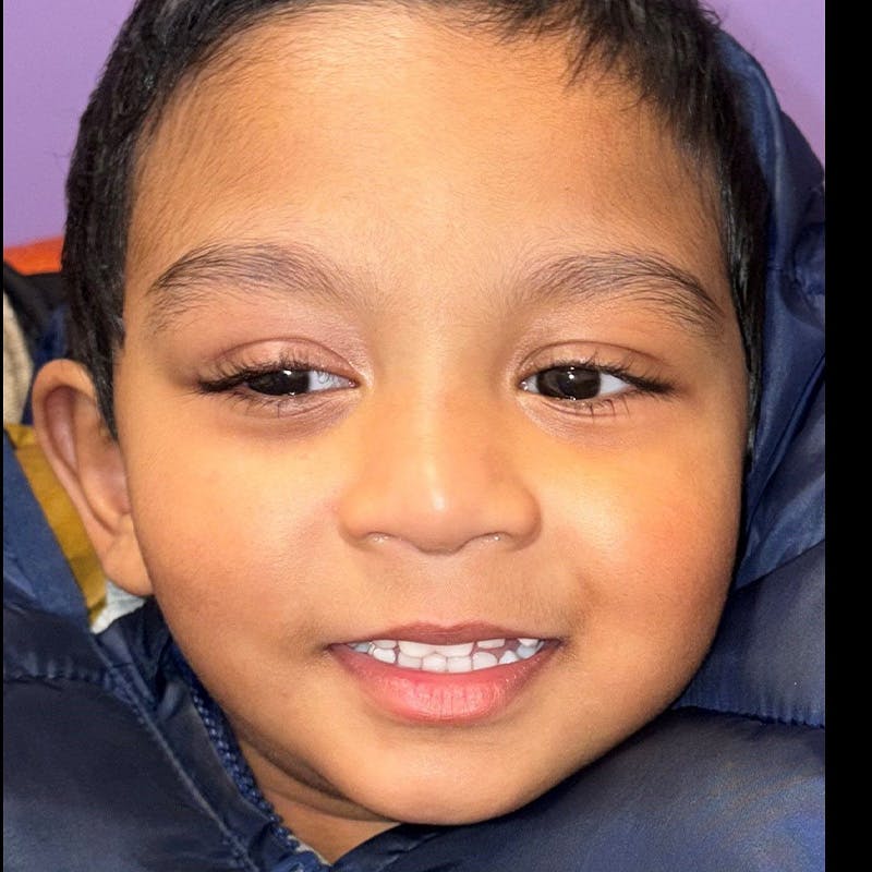 Ptosis Before & After Gallery - Patient 225039 - Image 2