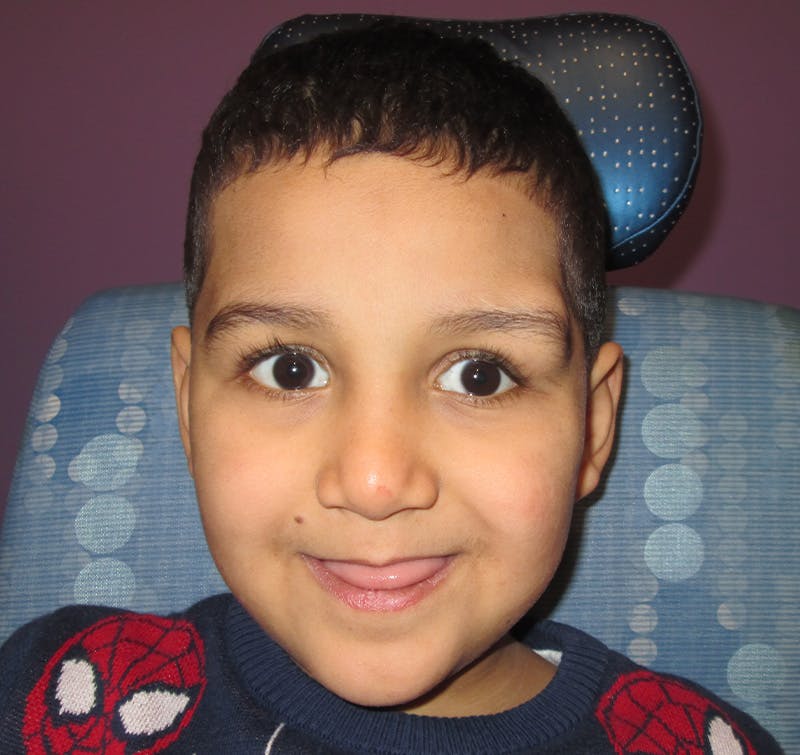 Dermoid Before & After Gallery - Patient 210334 - Image 1