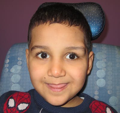 Dermoid Before & After Gallery - Patient 210334 - Image 1