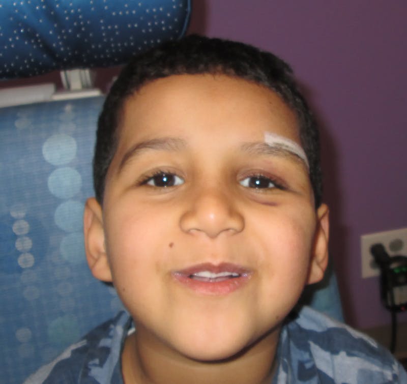 Dermoid Before & After Gallery - Patient 210334 - Image 2