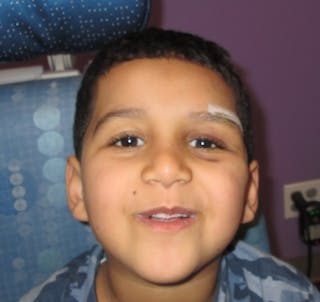 Dermoid Before & After Gallery - Patient 210334 - Image 2