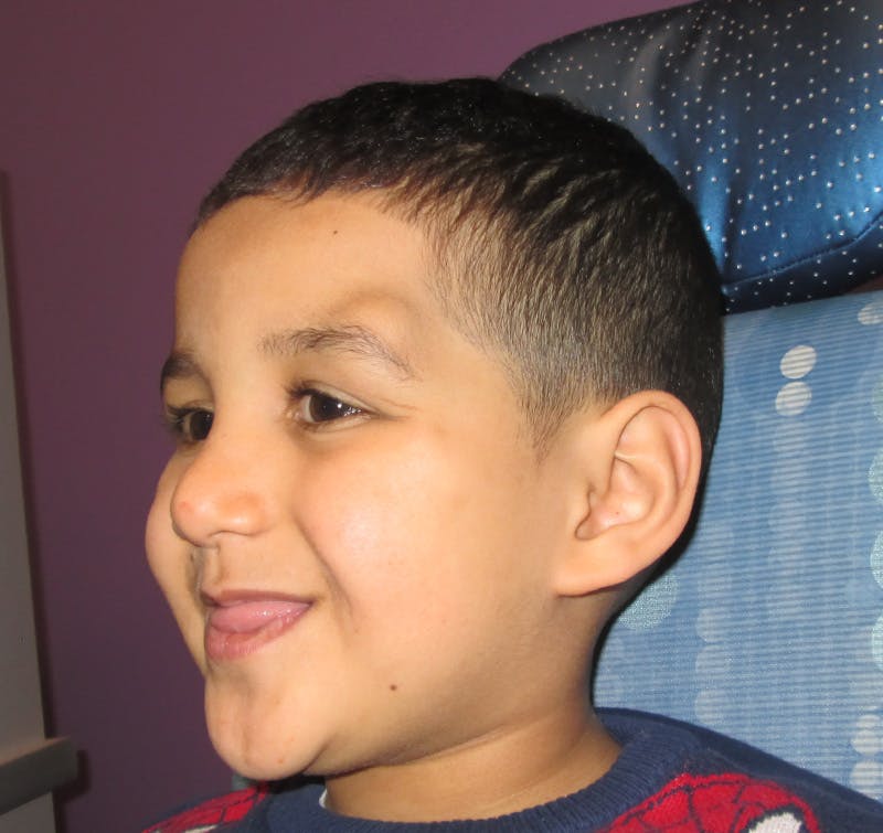 Dermoid Before & After Gallery - Patient 210334 - Image 3