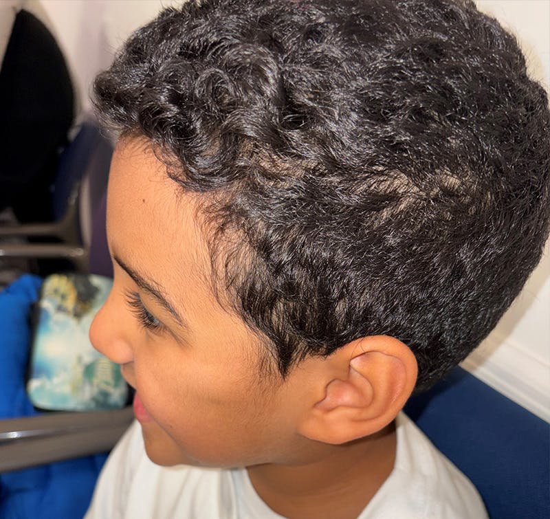 Dermoid Before & After Gallery - Patient 210334 - Image 4