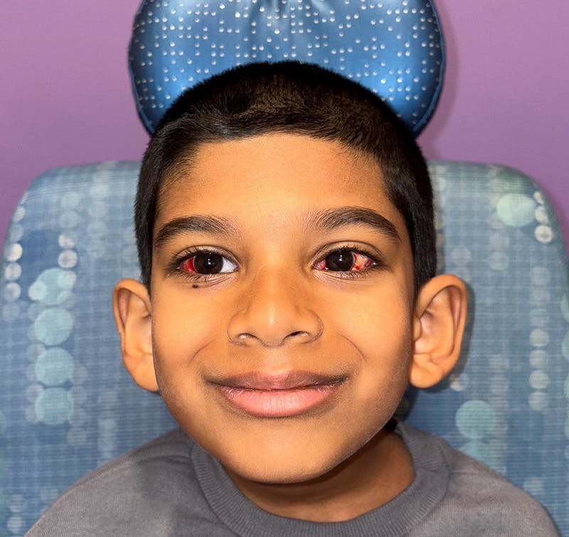 Exotropia Before & After Gallery - Patient 115749 - Image 2