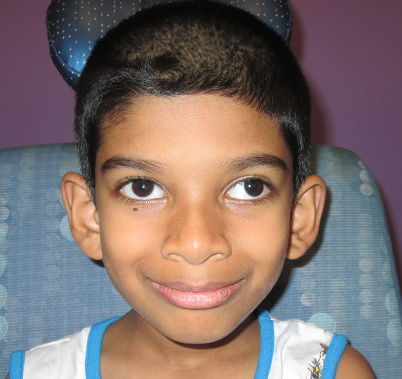 Exotropia Before & After Gallery - Patient 115749 - Image 1