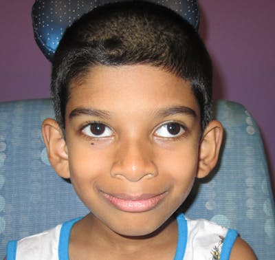 Exotropia Before & After Gallery - Patient 115749 - Image 1