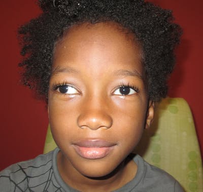 Exotropia Before & After Gallery - Patient 402149 - Image 1