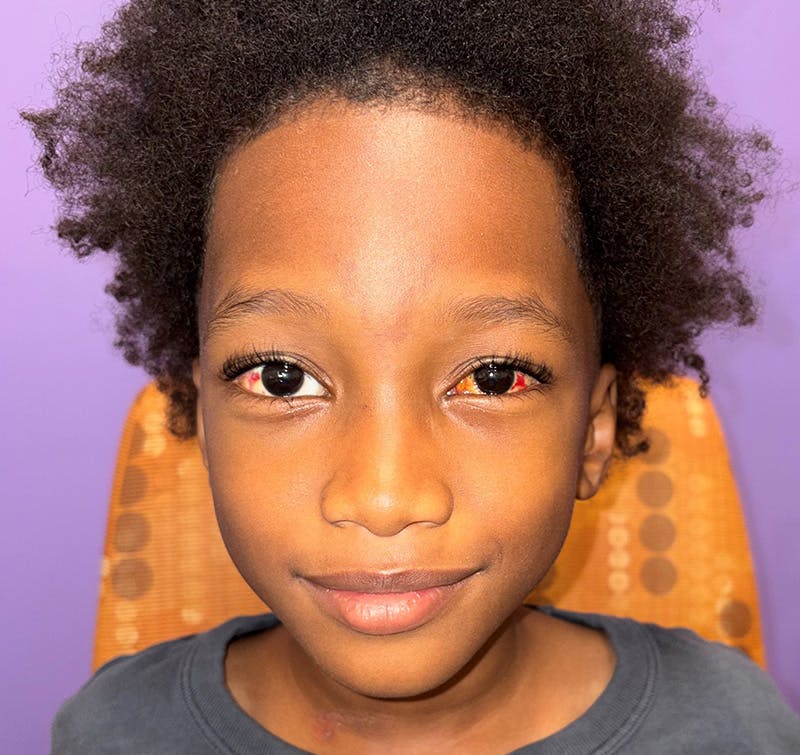 Exotropia Before & After Gallery - Patient 402149 - Image 2