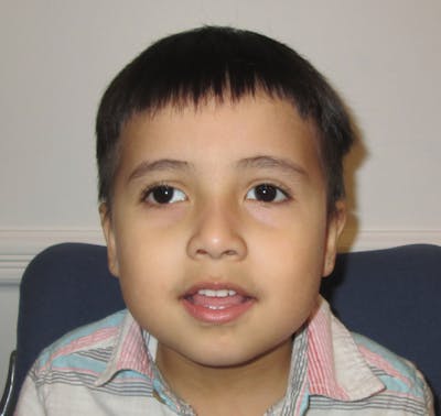 Exotropia Before & After Gallery - Patient 391476 - Image 1