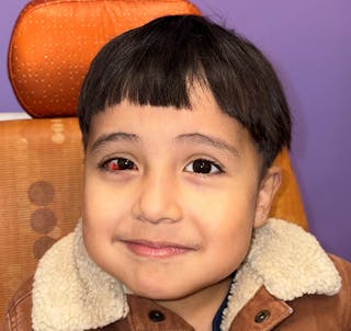 Exotropia Before & After Gallery - Patient 391476 - Image 2